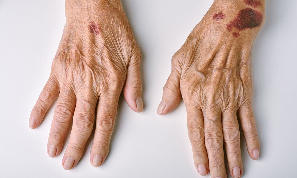 Elderly Bruised Skin